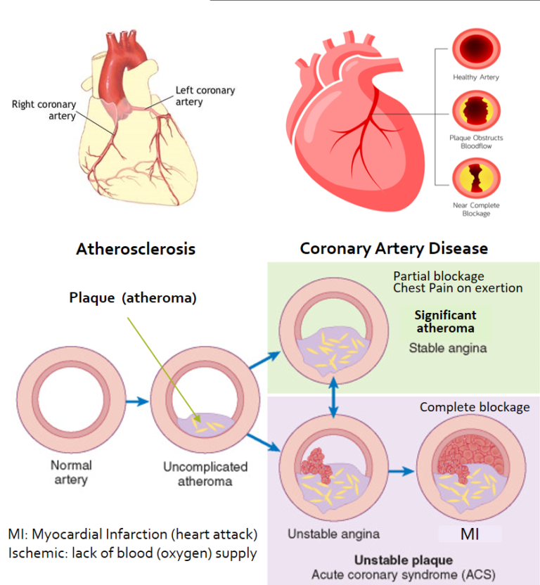 Cardiovascular Disease CVD Understanding Atherosclerosis And