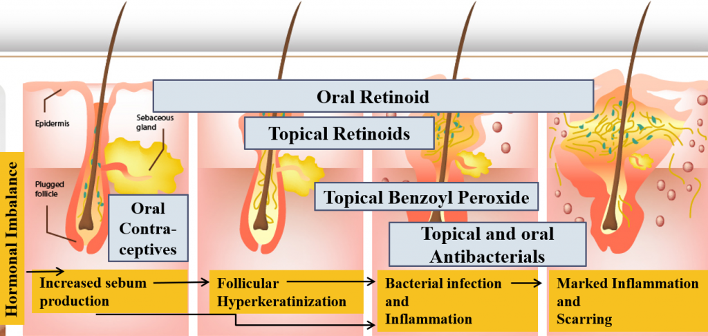 Acne Awareness And Understanding Dr Varsha Health Solutions