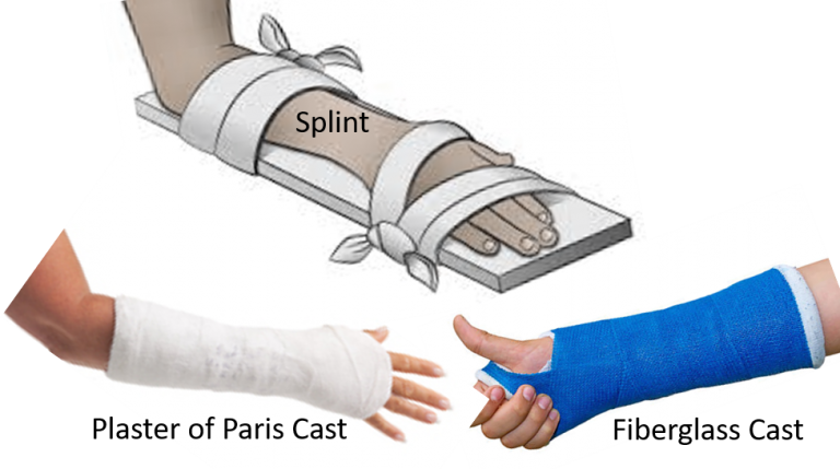 Fracture Casts And Splints