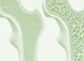Osteoporosis