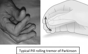 Parkinson tremor
