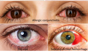 conjunctivitis