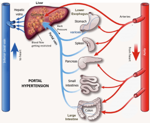 varices