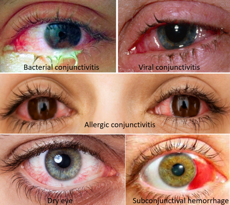 Causes And Precautions For Red Eyes Know The Alert Signs Drvarsha 