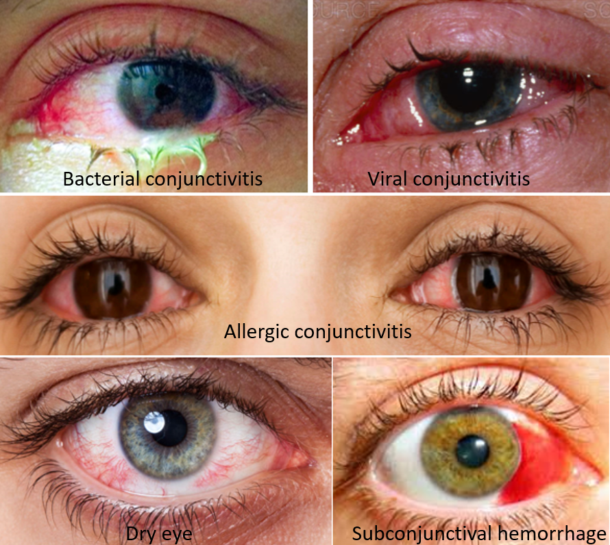 Conjunctivitis Viral Vs Bacterial