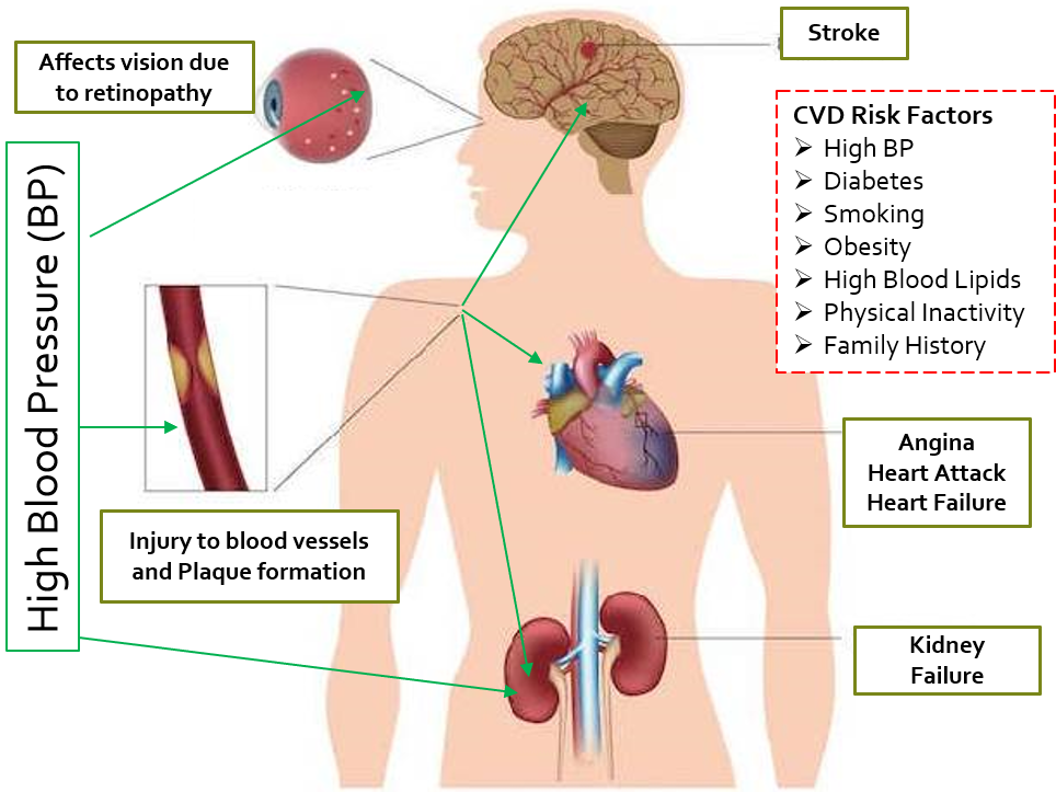 Complications of high BP