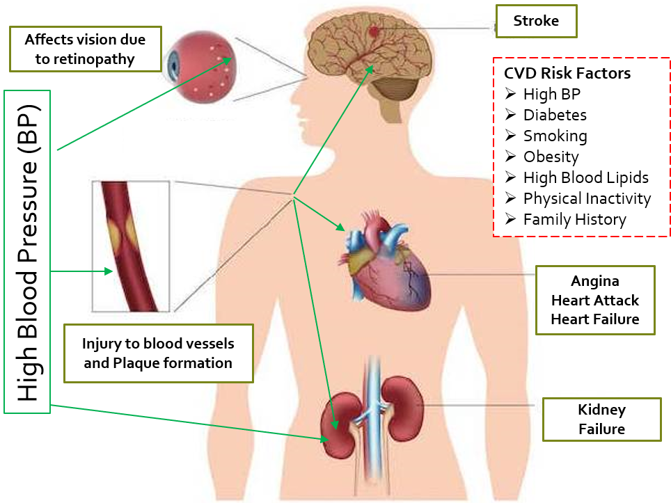 Complications on sale of hypertension