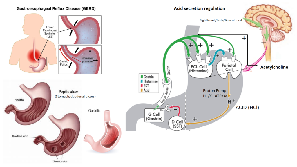 Acidity Reflux Disease (GERD), Dyspepsia (Indigestion) and Ulcers