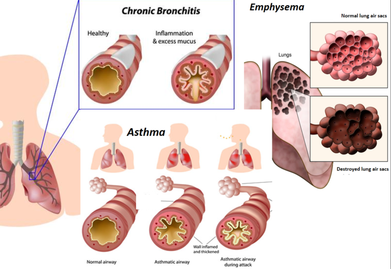 Asthma And Bronchitis Are Common Respiratory Conditions Drvarsha