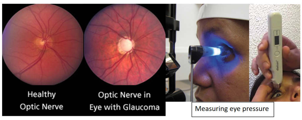 Glaucoma - What You Need To Know