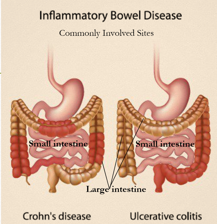 Inflammatory Bowel Disease Ibd Awareness Dr Varsha 