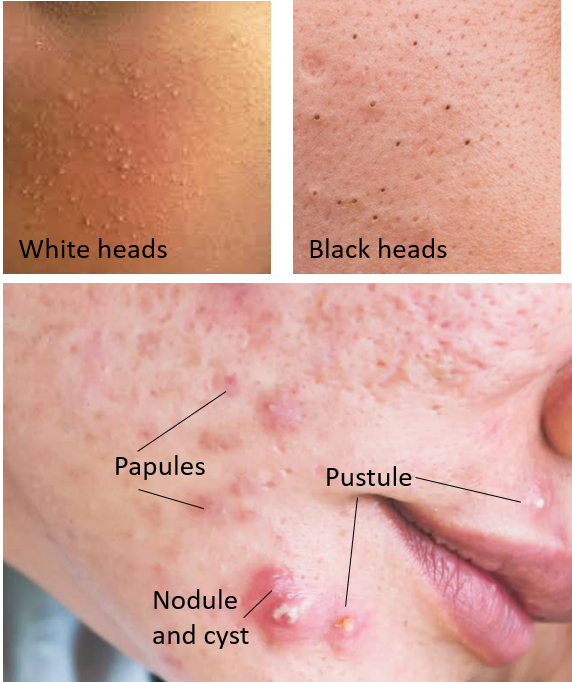 Stages of Acne