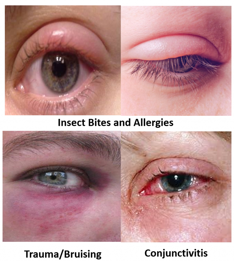 Swollen Eyelid Know The Causes Remedies And Alert Signs