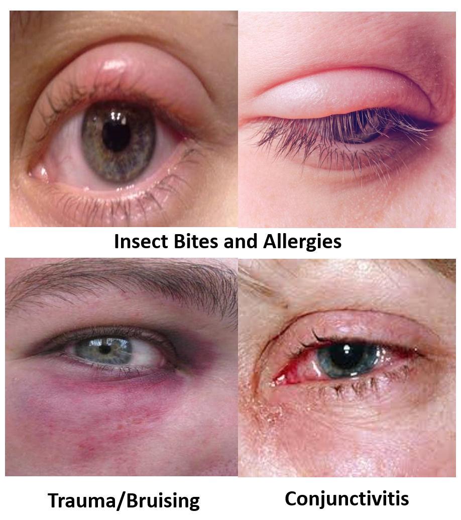 How To Reduce Swollen Eyes From Insect Bites Infoupdate