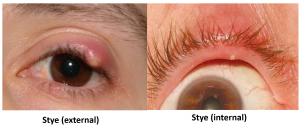 Stye