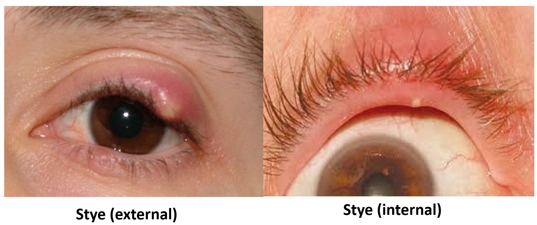 Bed Bug Bites On Eyelid