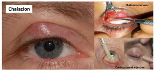 chalazion