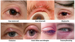 eyelid swellings