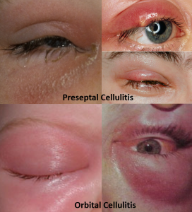 Swollen Eyelid - Know The Causes, Remedies And Alert Signs