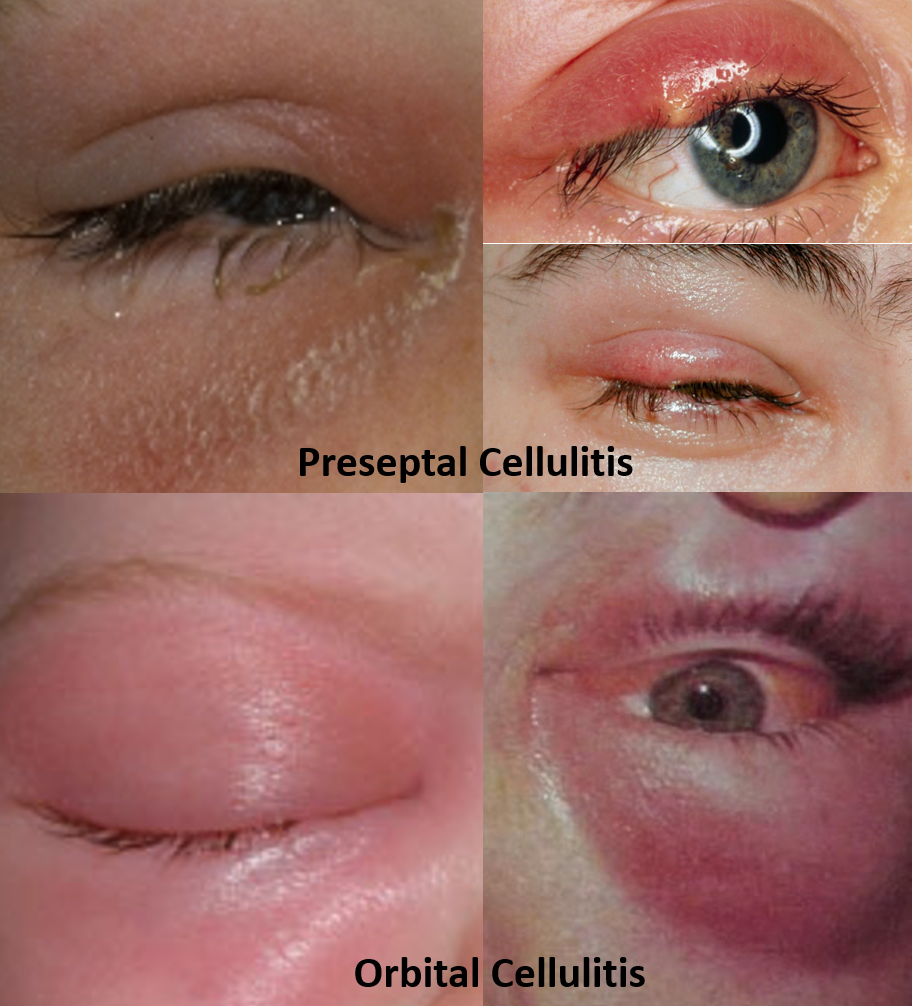 eyelid cellulitis