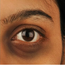 Dark Circles - Why they occur and Holistic remedies