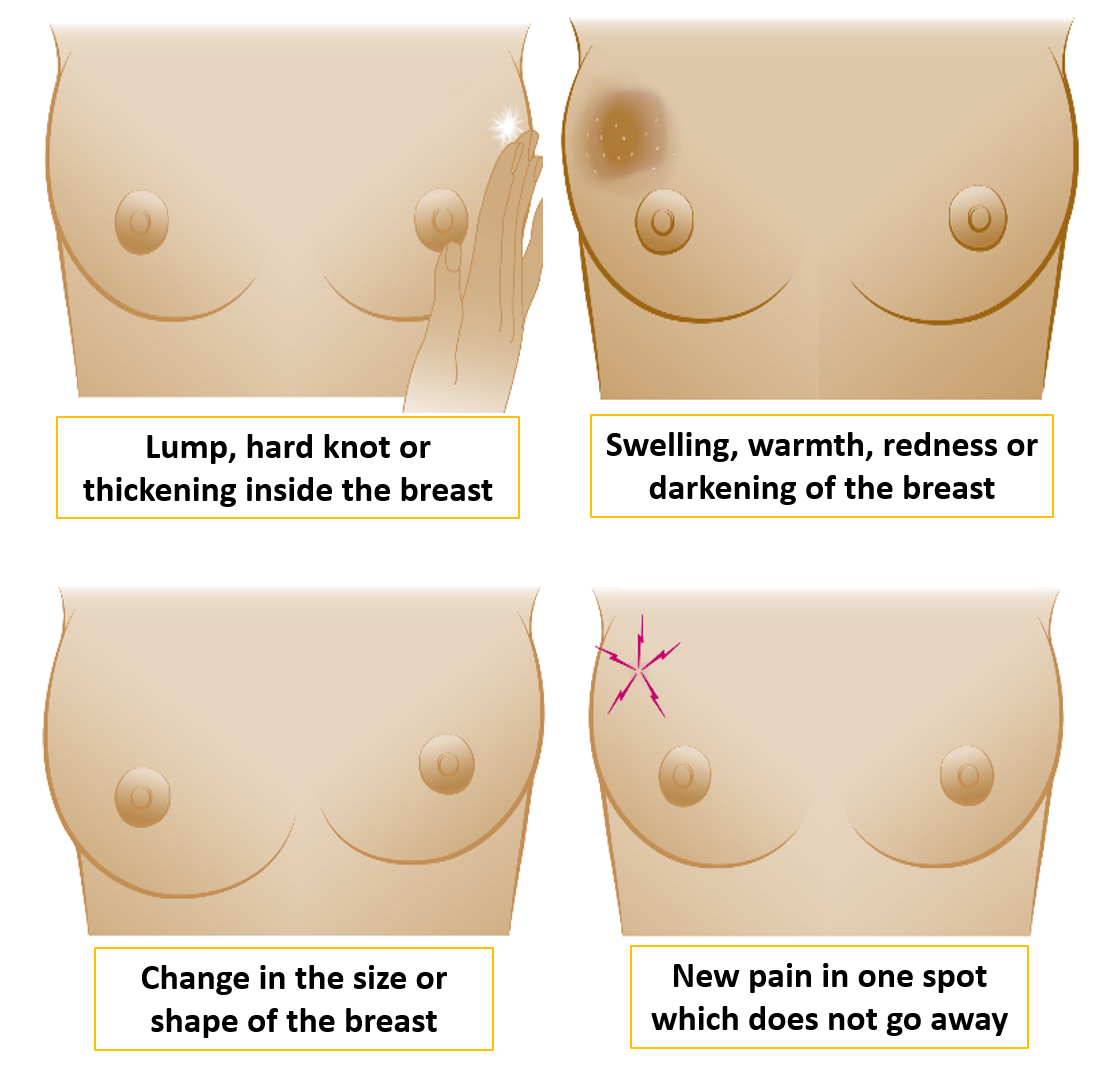 Breast cancer warning signs