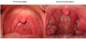 sore pharyngitis thrush candida immunity compromised characteristic drvarsha