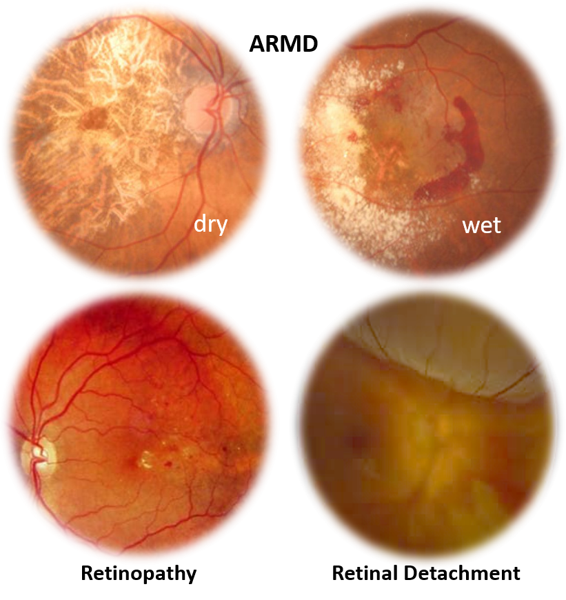 Retinopathy ARMD RD