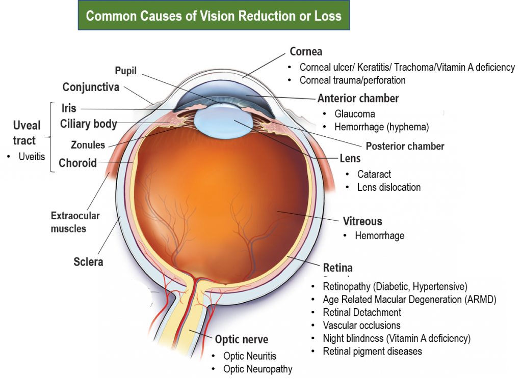 vision-reduction-and-loss-understanding-causes-and-points-for-timely