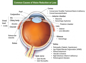 Vision reduction