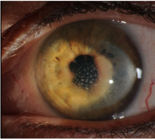 iridocyclitis