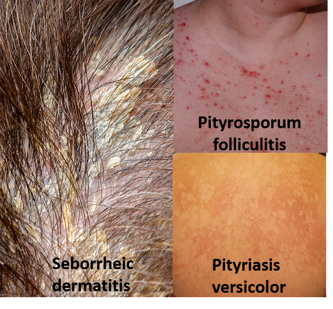 seborrheic dermatitis