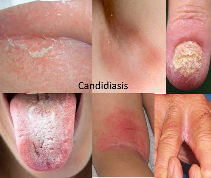 candida infections