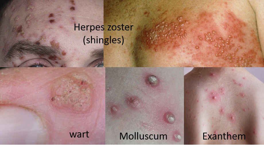 herpes warts