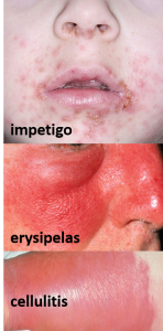 impetigo erysipelas cellulitis