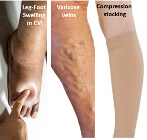 varicose veins