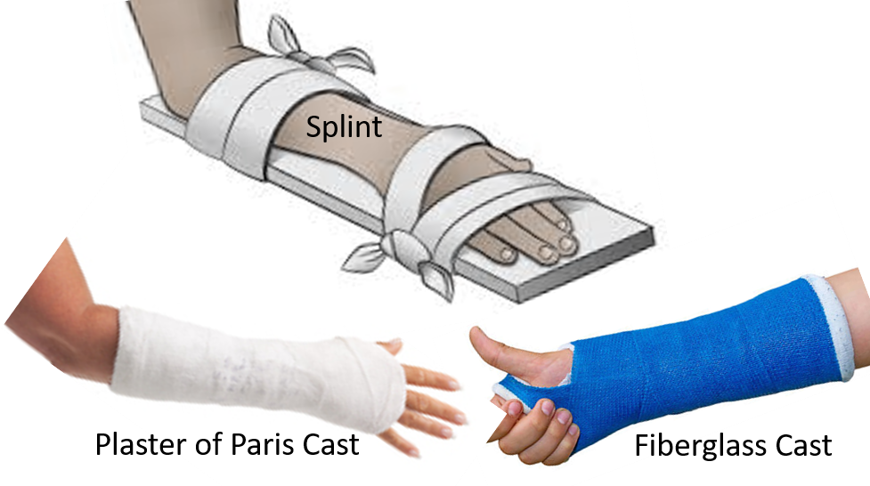 Difference Of Splint And Cast At Missy Lynch Blog Difference Of Splint And Cast At Missy Lynch Blog