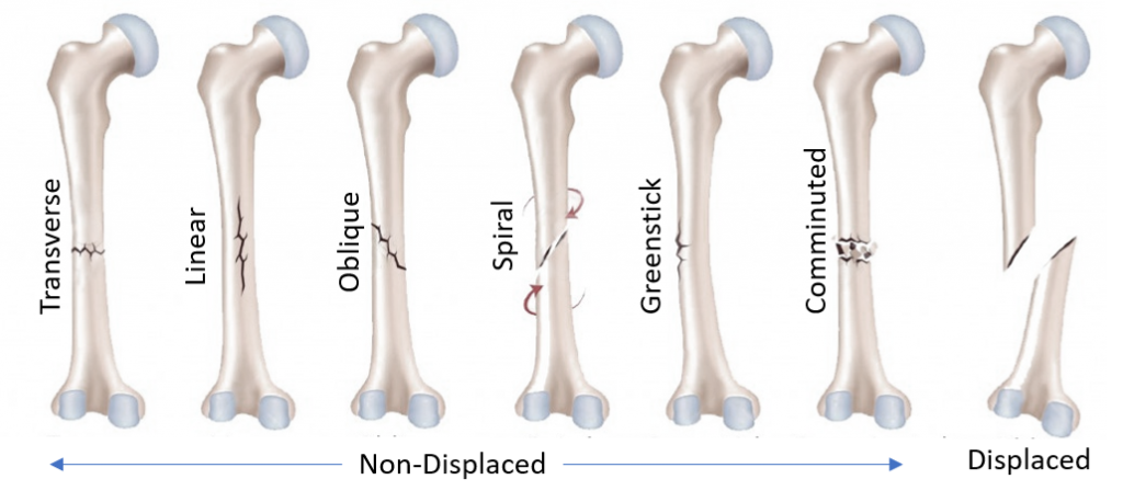 Acute Injuries: Bruise, Hematoma, Sprain-Strains, Fracture and Dislocation