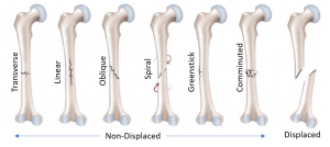 fracture types