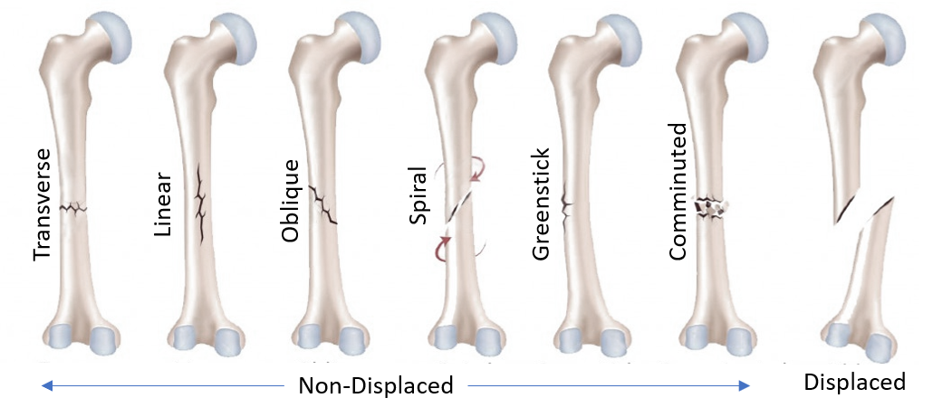 fracture types