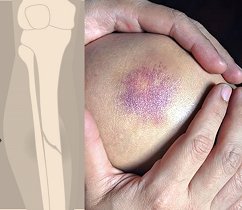 acute blunt injuries