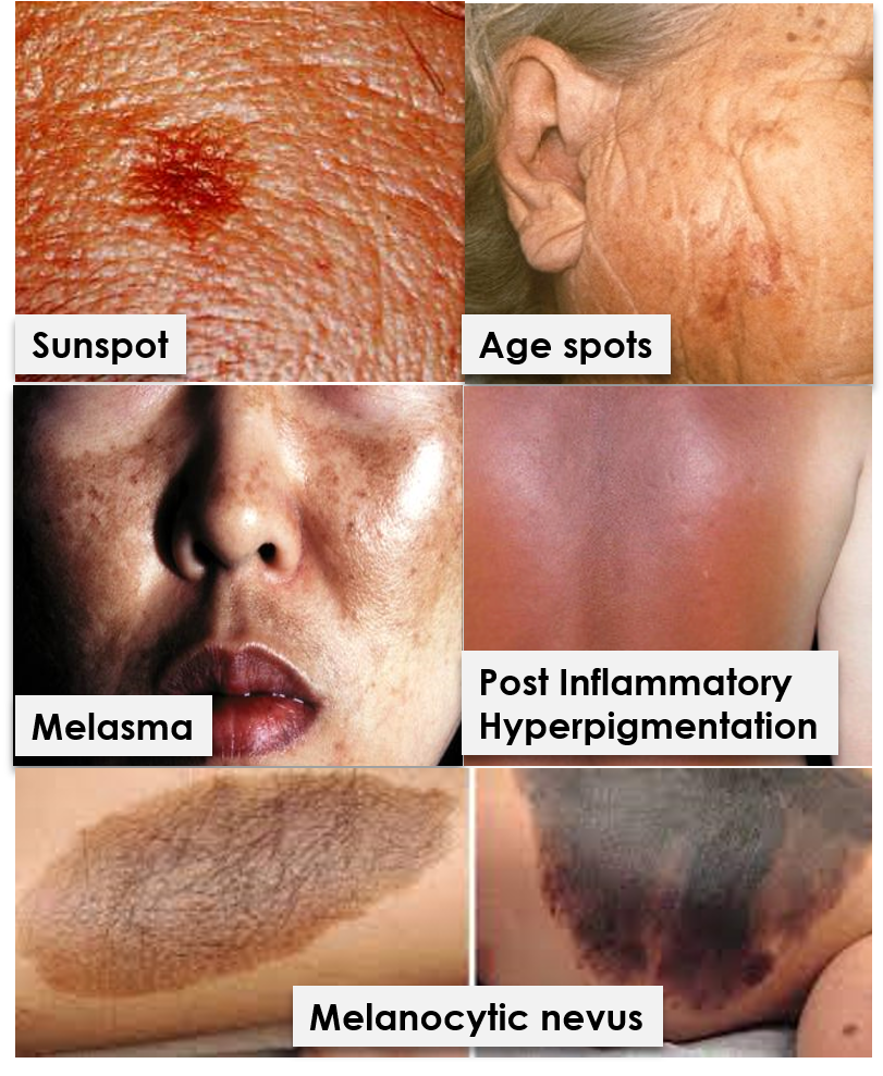 Hyperpigmentation Understanding Dark Patches On Skin