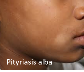 Pityriasis alba