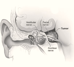 inner ear tumor