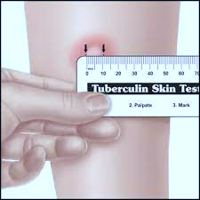 Tuberculin Skin Test