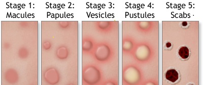 Monkeypox stages