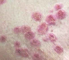 monkeypox