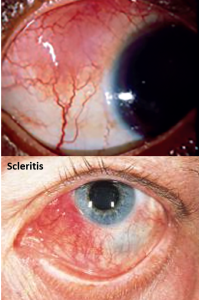 scleritis