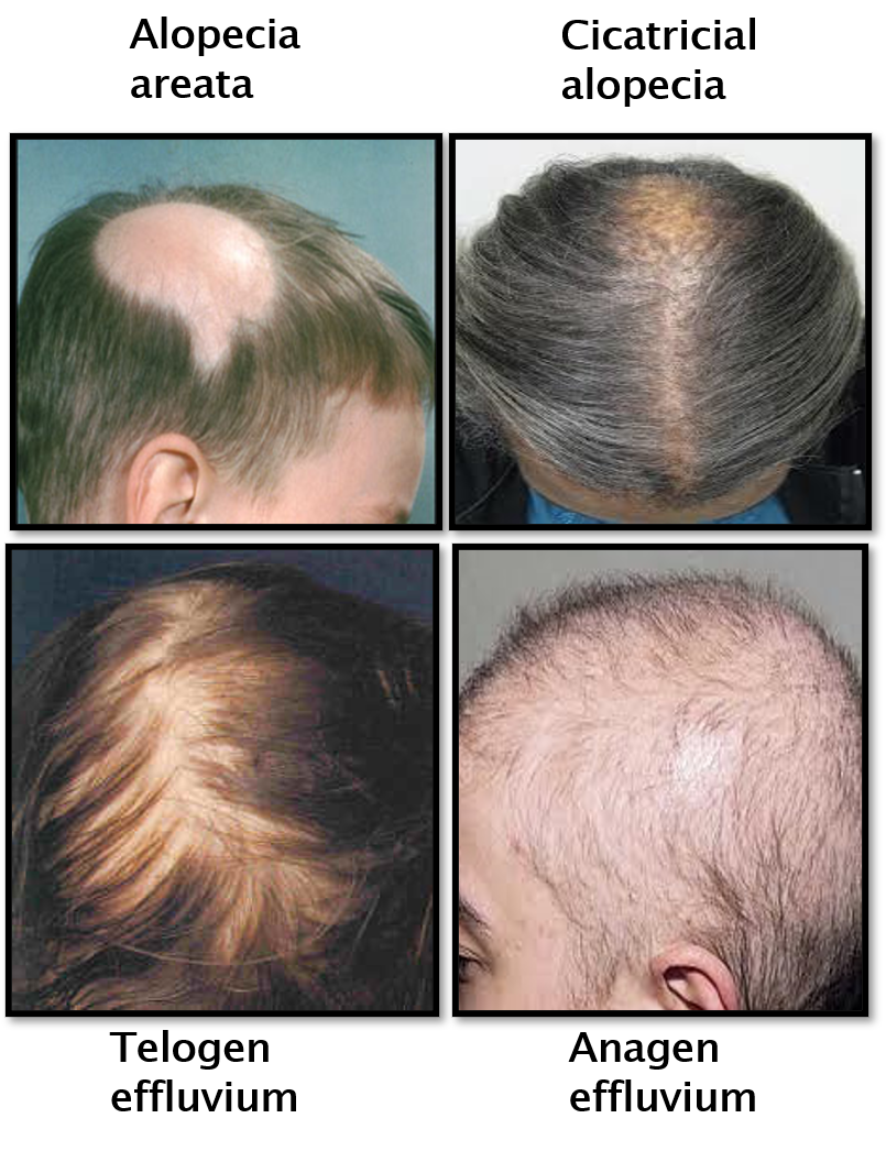 alopecia and effluvium