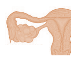 Ovarian cysts